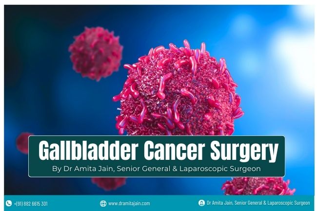 Best Gallbladder Cancer Surgeon in Delhi Dr Amita Jain